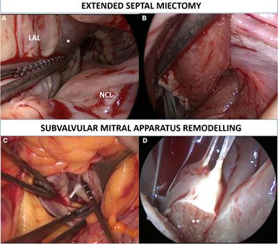 Septal Thickness Does Not Impact Outcome After Hypertrophic Obstructive Cardiomyopathy Surgery (Septal Myectomy and Subvalvular Mitral Apparatus Remodeling): A 15-Years of Experience